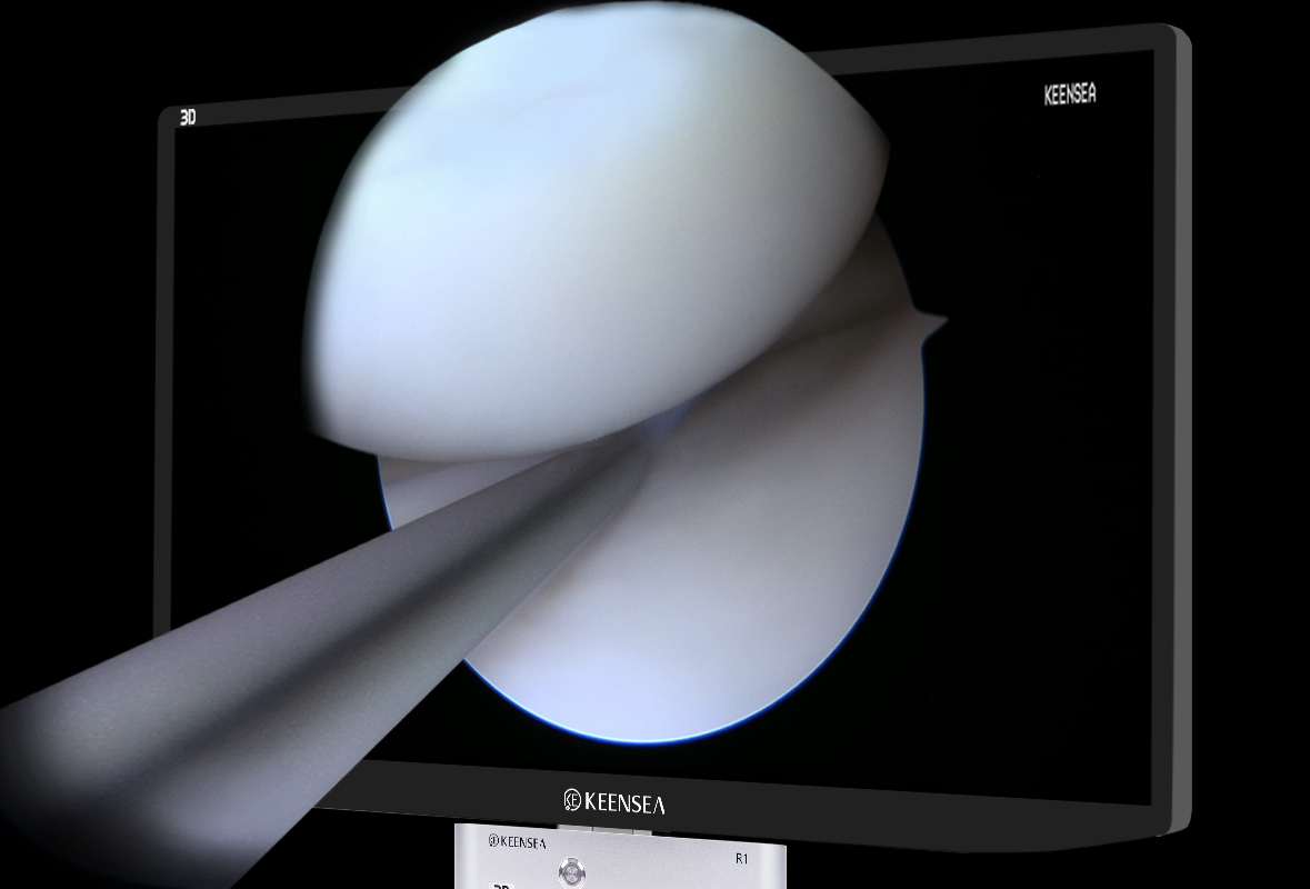尊龙凯时医疗助力上海十院成功完成首例3D关节镜下臀肌挛缩松解术--同济医院 尊龙凯时医疗助力上海十院成功完成首例3D关节镜下臀肌挛缩松解术--同济医院